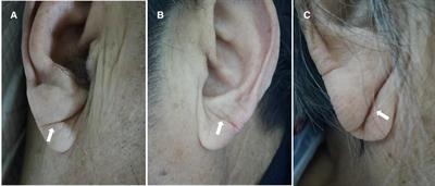 The prognostic value of deep earlobe creases in patients with acute ischemic stroke